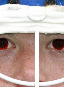 Beth Storry shows off the special contact lenses. Beth Storry shows off the special contact lenses.