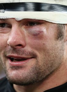 Richie McCAw shiner close up Richie McCAw shiner close up