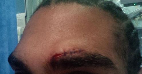 Cut down: David Haye and Tyson Fury have both been stopped by a cut